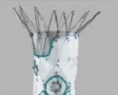 Cook Medical Zenith p-Branch Off-the-Shelf Fenestrated Stent Graft | Which Medical Device